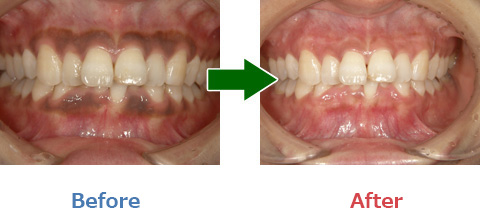 レーザー治療での歯ぐきのメラニン除去症例写真