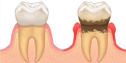 歯周病治療イメージ