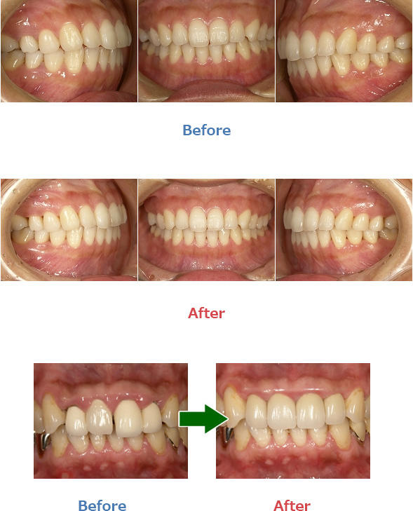 歯周病治療施術写真